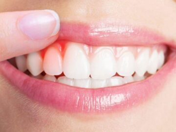كيفية علاج التهاب اللثة داخل المنزل وماهي علامات الالتهاب!!