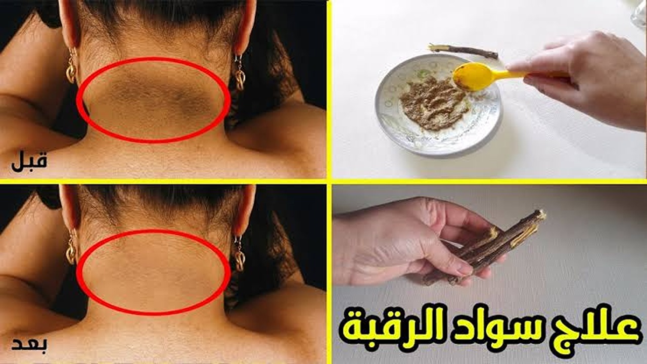 الفرق هيبان من أول مرة.. طريقة تحضير وصفة لتبييض الرقبة والتخلص من الاسمرار والجلد الميت بمكونات طبيعية