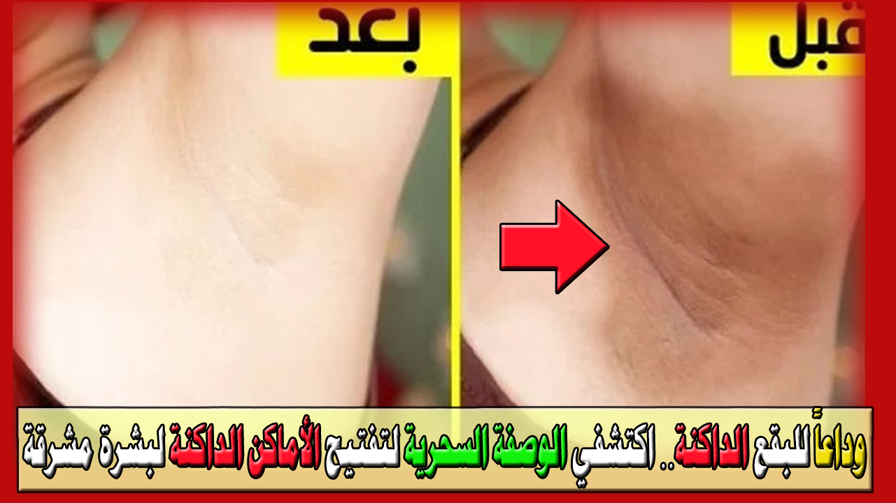وداعاً للبقع الداكنة… اكتشفي الوصفة السحرية لتفتيح الأماكن الداكنة لبشرة مشرقة ونضرة في أيام