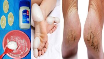 وصفة للتخلص من تشقق القدمين والجلد الميت بدون ترك أي بكتيريا أو خشونة