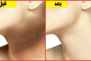 خلطة عبقرية هتخلصك من اسمرار الرقبة وسبب ظهور تصبغات رقبتك هي إيه اعرفيها