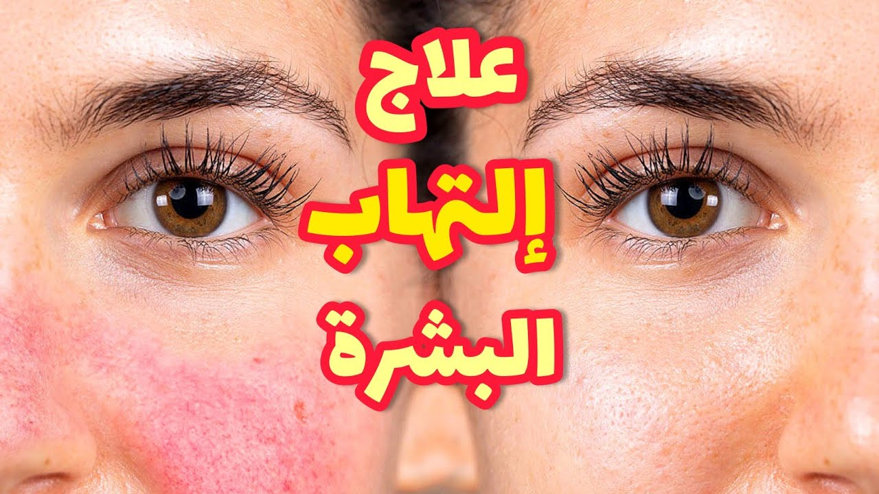 وداعًا لاحمرار وتهيج البشرة بعد إزالة شعر الوجه..إليك أفضل الخلطات الطبيعية الآمنة 5 وداعًا لاحمرار وتهيج البشرة بعد إزالة شعر الوجه..إليك أفضل الخلطات الطبيعية الآمنة