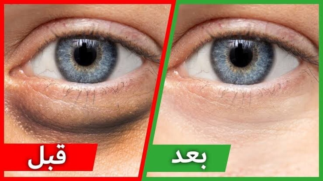 رجعي عيونك تنور تاني.. أفضل الطرق الطبيعية للتخلص من الهالات السوداء بشكل مبهر