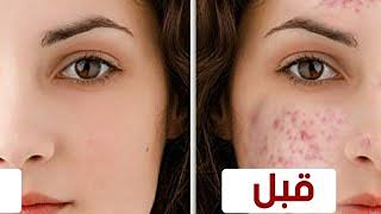 تخلصي من حب الشباب بمكون فعال رخيص الثمن.. وصفة طبيعية بدون كيماويات