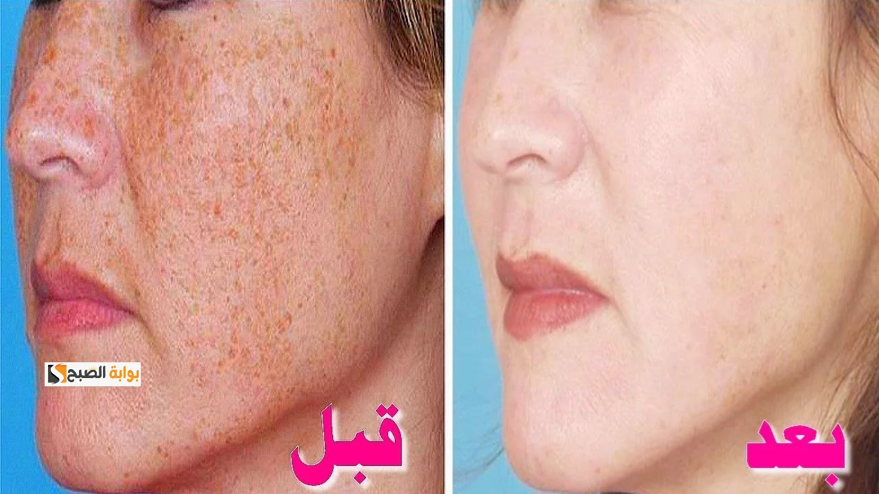أسباب ظهور حبوب الوجه والجبهة وطريقة التخلص منها 