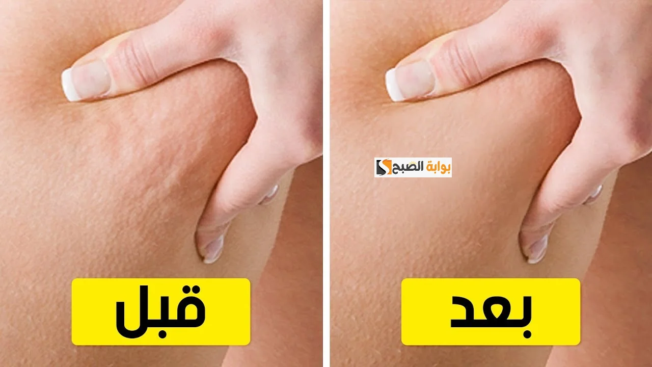 سهلة وغير مكلفة.. تعالى اقولك على وصفات طبيعية فعالة لحل مشكلة السيلوليت