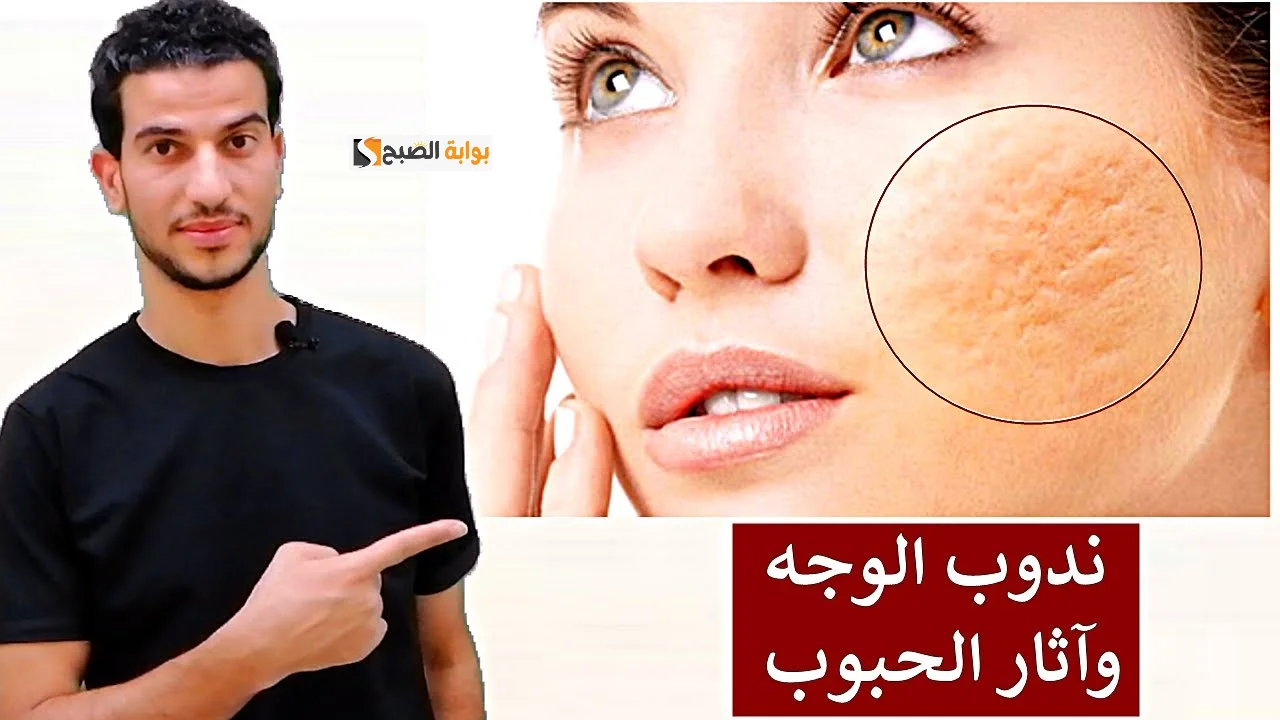 رجعي وشك لطبيعته .. وصفة طبيعية تخلصك من آثار حب الشباب.. تعرف عليها
