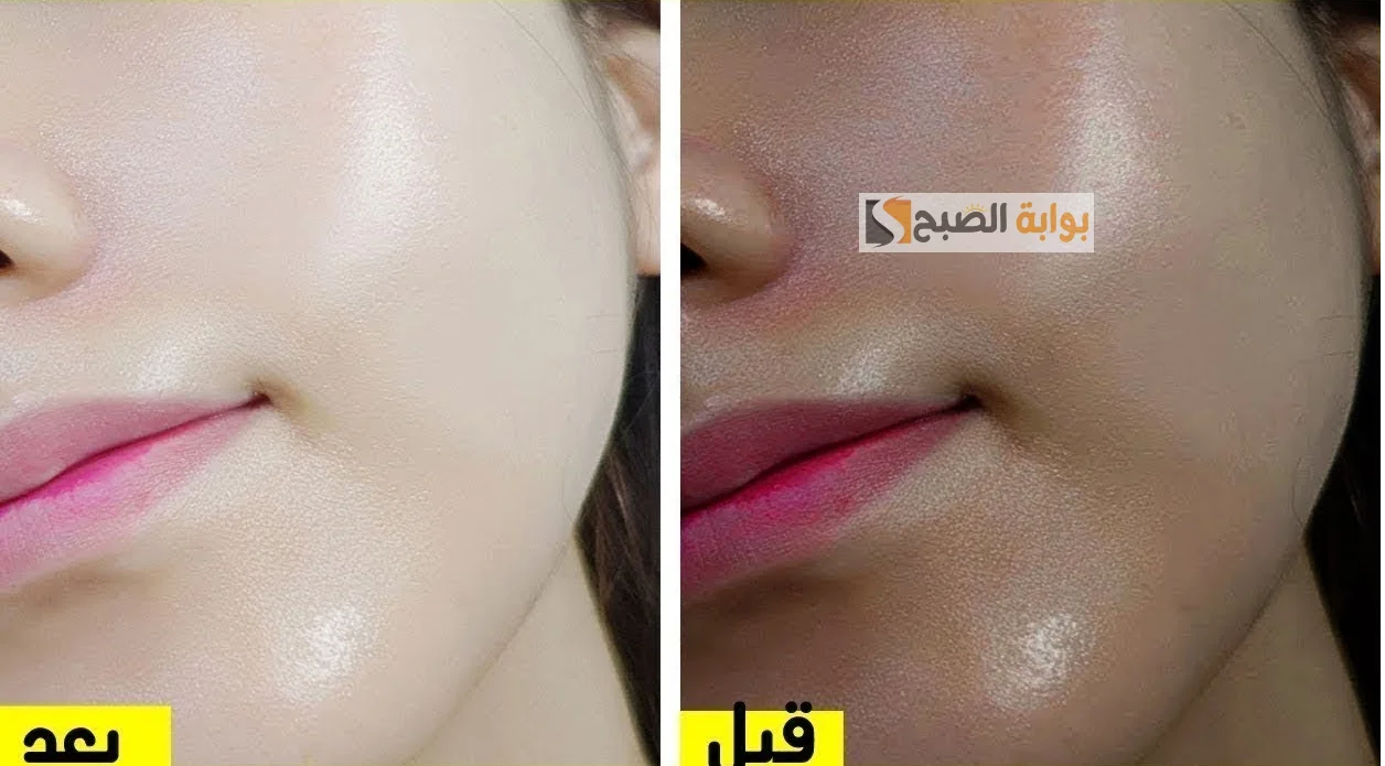 لبشرة زجاجية.. قناع المرة والعسل هو الحل السحري لتفتيح البشرة والتخلص من آثار حب الشباب والندبات