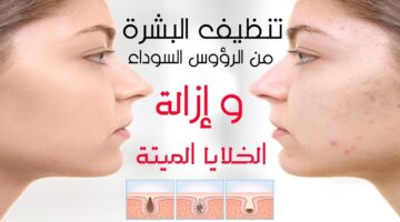 تقشير البشرة