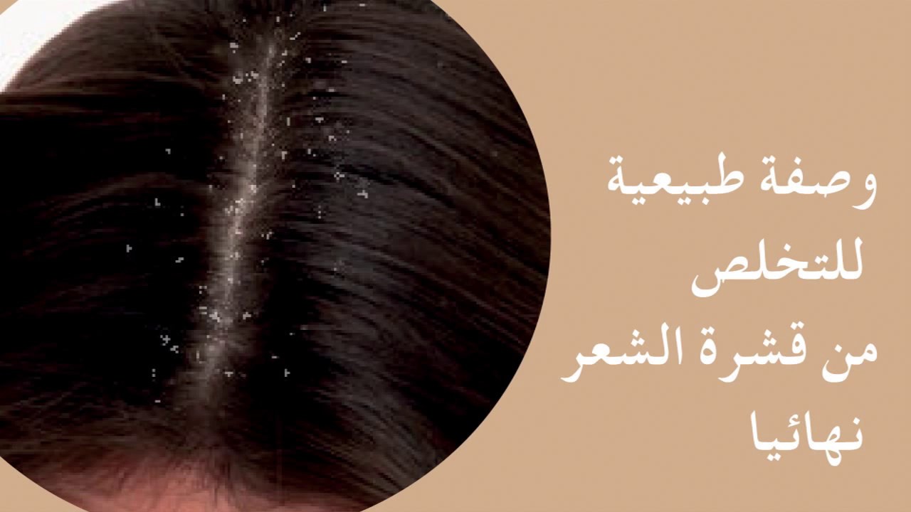 طرق طبيعية وفعالة للتخلص من القشرة بمكونات موجودة في البيت 5 طرق طبيعية وفعالة للتخلص من القشرة بمكونات موجودة في البيت