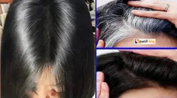 علاج الشيب الأبيض بالموز