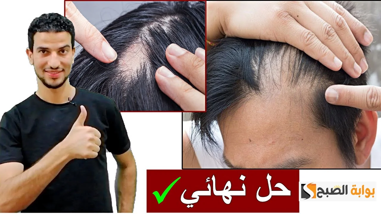 هتملى كل الفراغات.. سيروم القرنفل والروزماري لكثافة الشعر وإنبات الفراغات مجربة ومضمونة