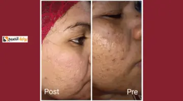 وصفات طبيعية لتفتيح البشرة