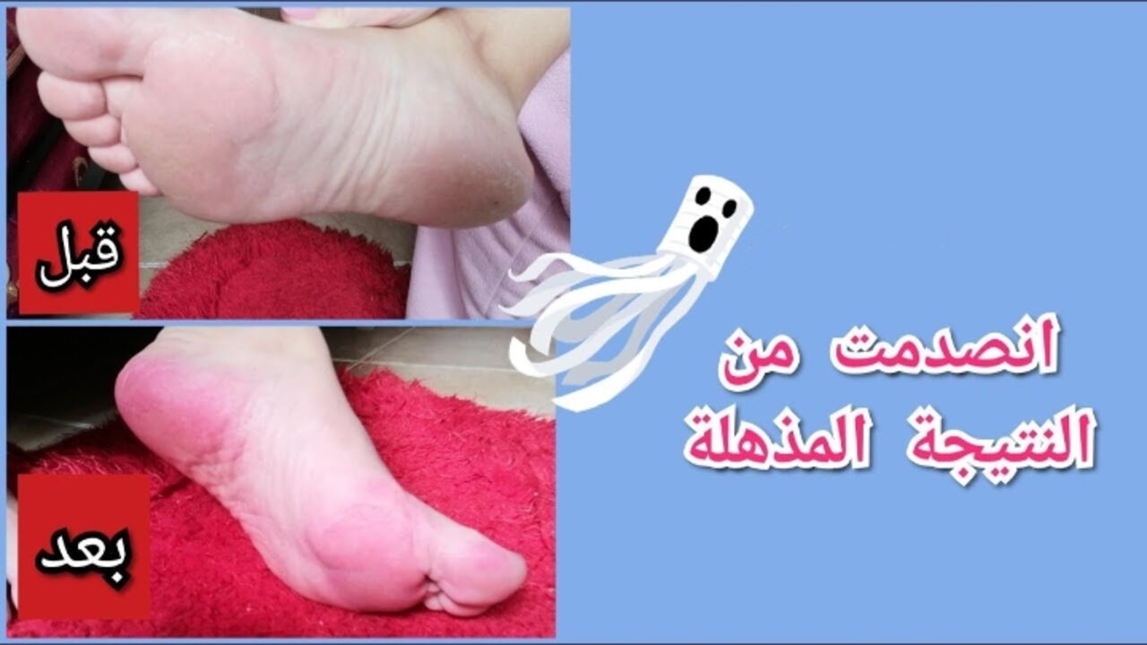 ثقة وأناقة في كل خطوة.. تخلصي من خشونة وتشققات القدمين مع مقشر القهوة الرائع