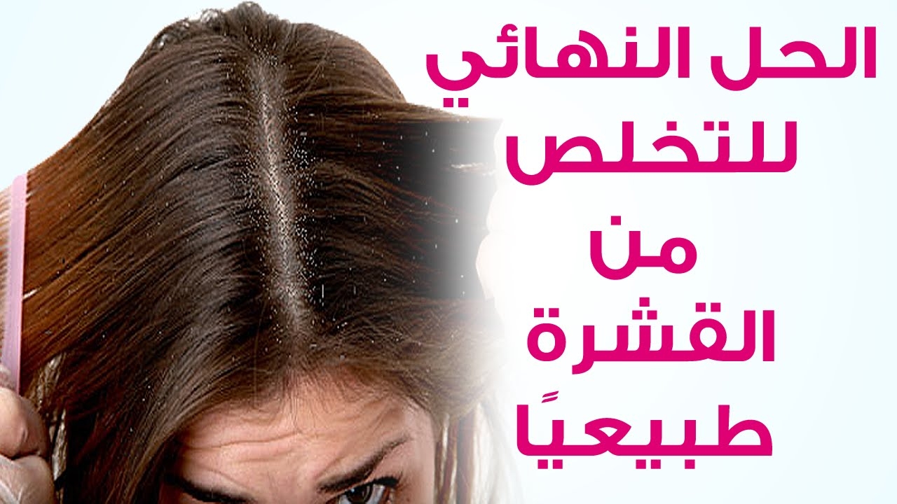 الحل النهائي وأفضل الوصفات للتخلص من قشرة الشعر بطرق طبيعية وآمنه