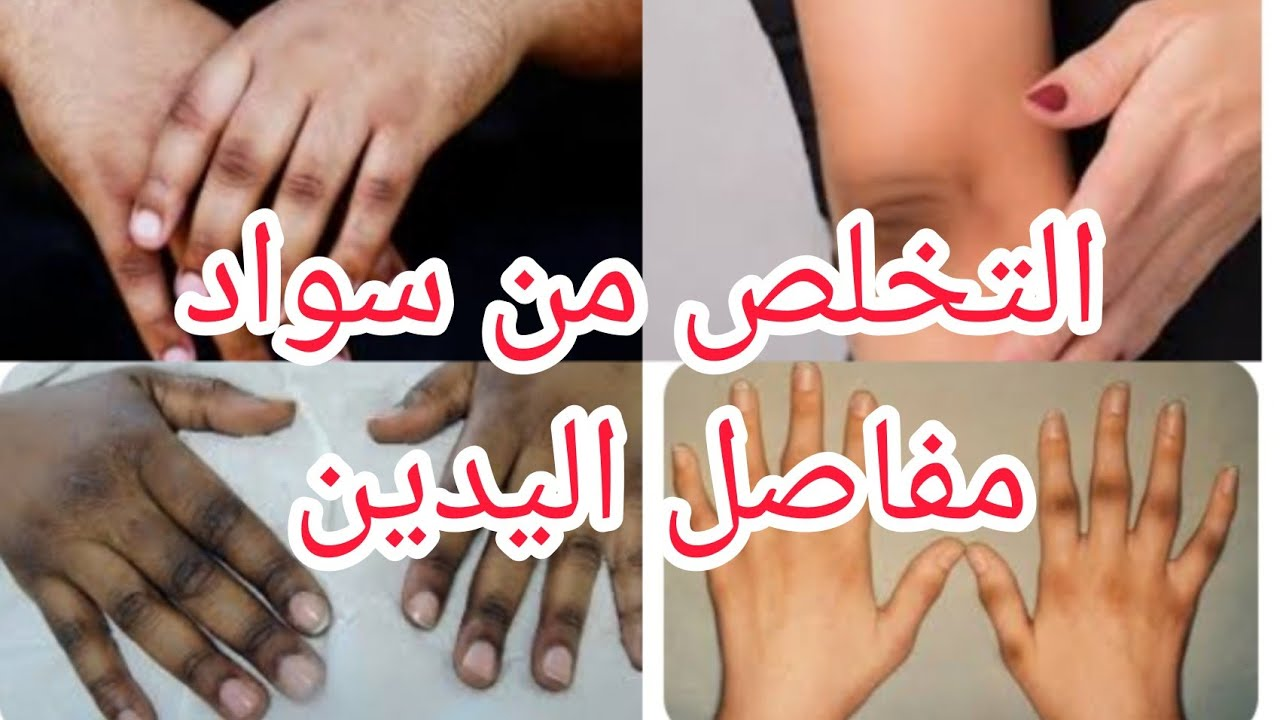 لتفتيح مفاصل اليدين..إليك 3 وصفات طبيعية بنتيجة مذهلة من أول أسبوع