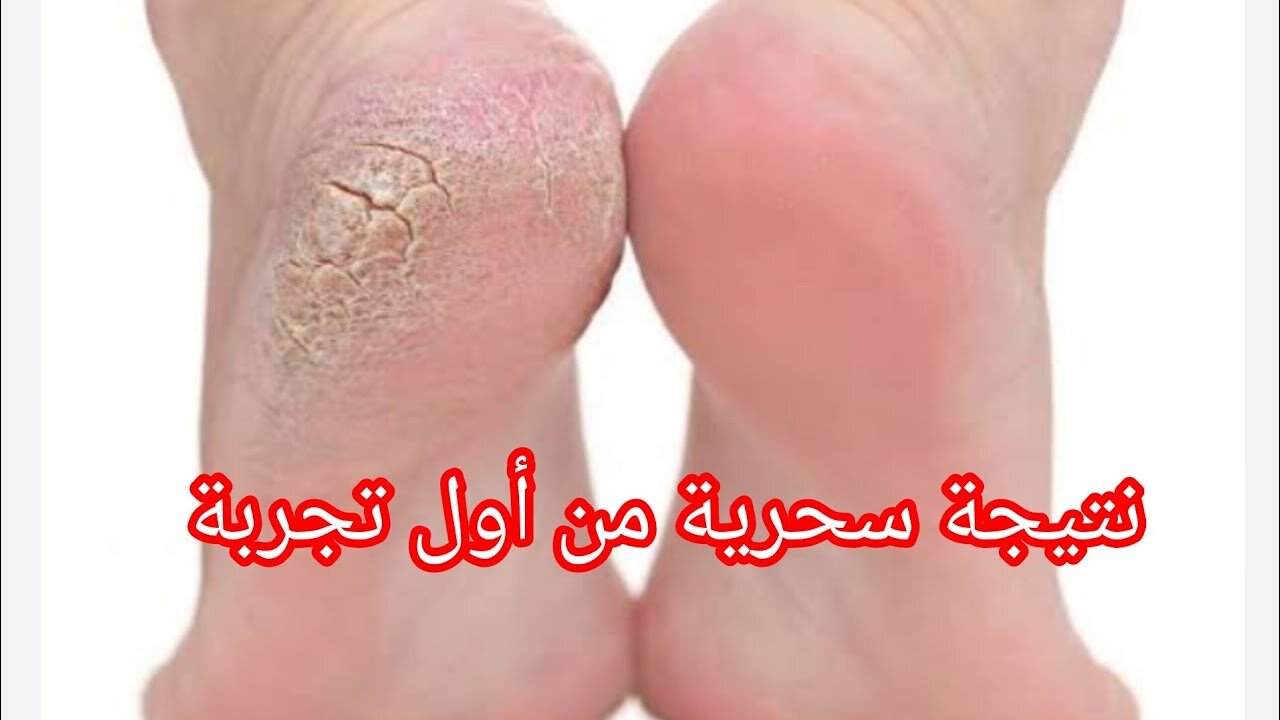 كأنك لسه عامله جلسة باديكير.. ودعي تشققات القدمين وجفاف الجلد مع هذا المقشر المنزلي الرائع