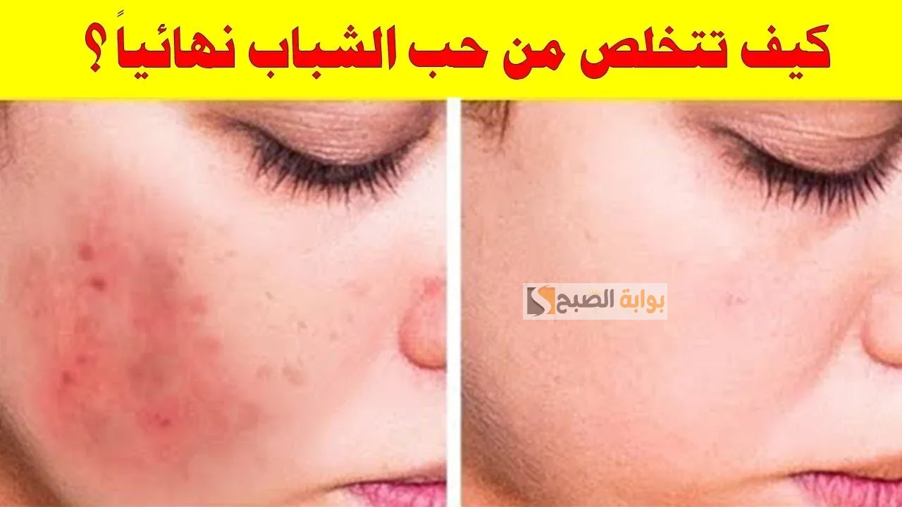 وصفات طبيعية للتخلص من حب الشباب قبل أي مناسبة .. استعدى ببشرة صافية