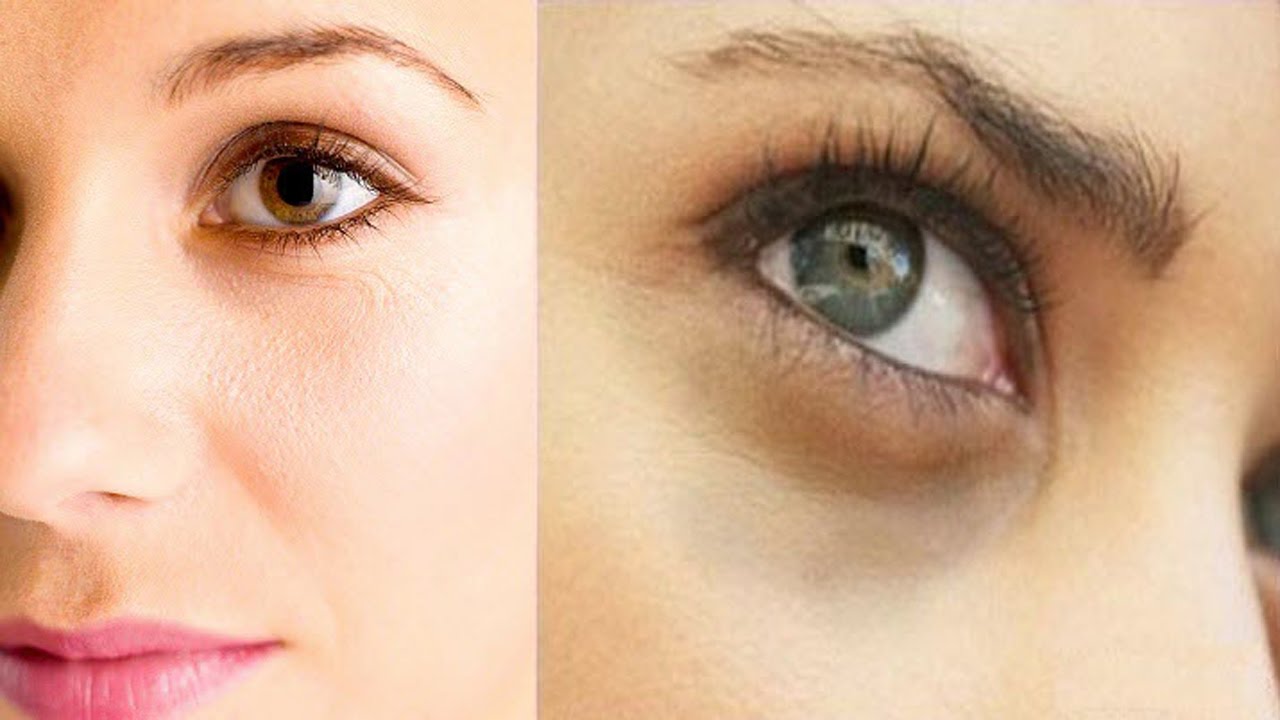 طرق طبيعية للتخلص النهائي من الهالات السوداء أسفل العين