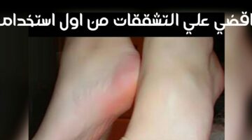 تشققات القدمين 1