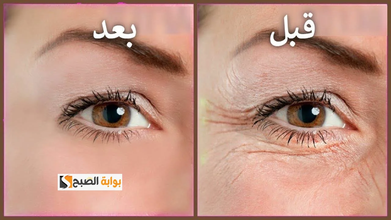 لبشرة أكثر شباب.. وصفات طبيعية لعلاج تجاعيد العين هترجعي العشرينات