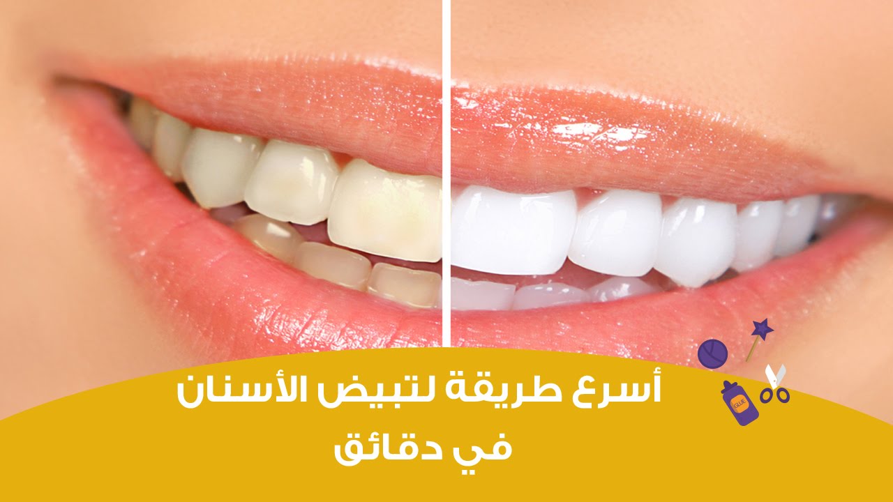 هترجع بيضاء تمامًا .. وصفة خرافية لتبيض الأسنان في البيت بدون تكلفة