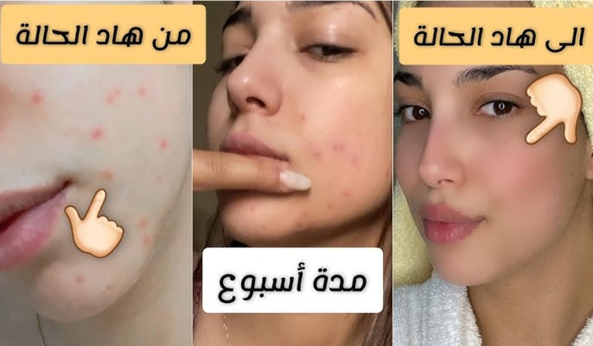 أسهل وأسرع ماسك لتفتيح البشرة والقضاء على الحبوب بمكونات في المنزل والنتيجة ممتازة