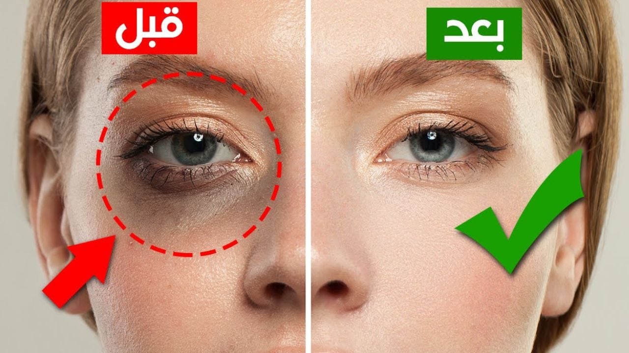 خليكي دائمًا مشرقة.. طريقة عمل قناع العسل لعلاج الهالات السوداء والاسمرار حول العين النتيجة مبهرة