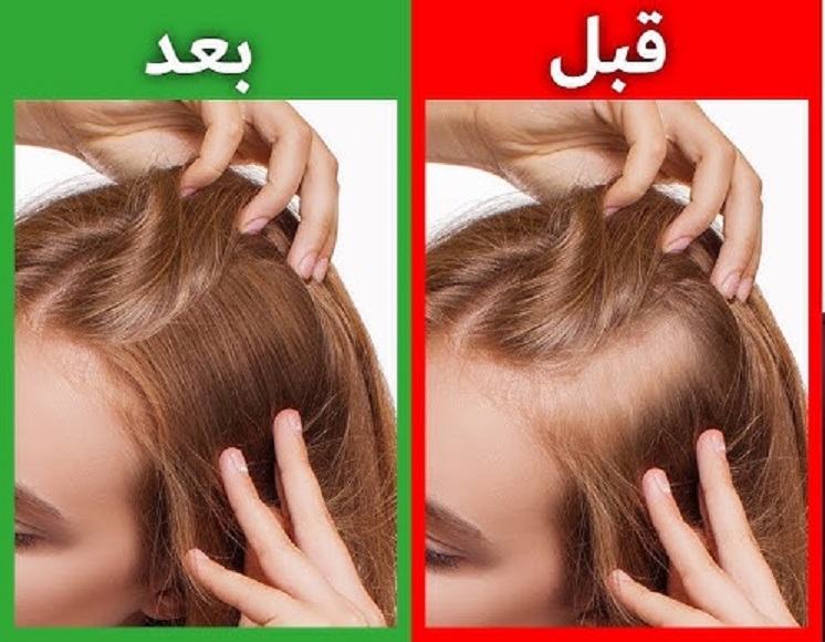 الحل النهائي “بدون كيماويات”.. وصفات منزلية تعالج تساقط الشعر