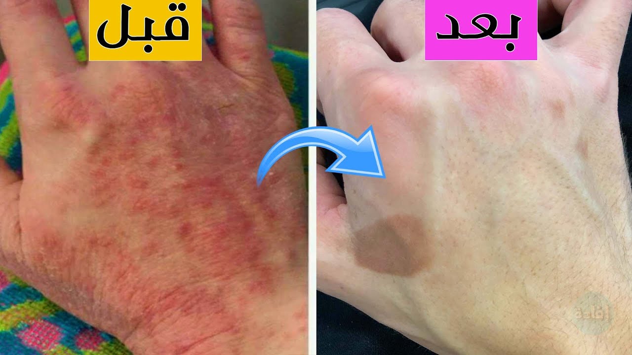 وصفة طبيعية للتخلص من جفاف اليدين والرجلين في الشتاء.. وداعاً للتشققات
