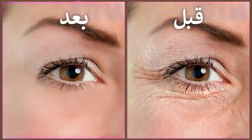 وصفات طبيعية للتخلص من تجاعيد تحت العين 1
