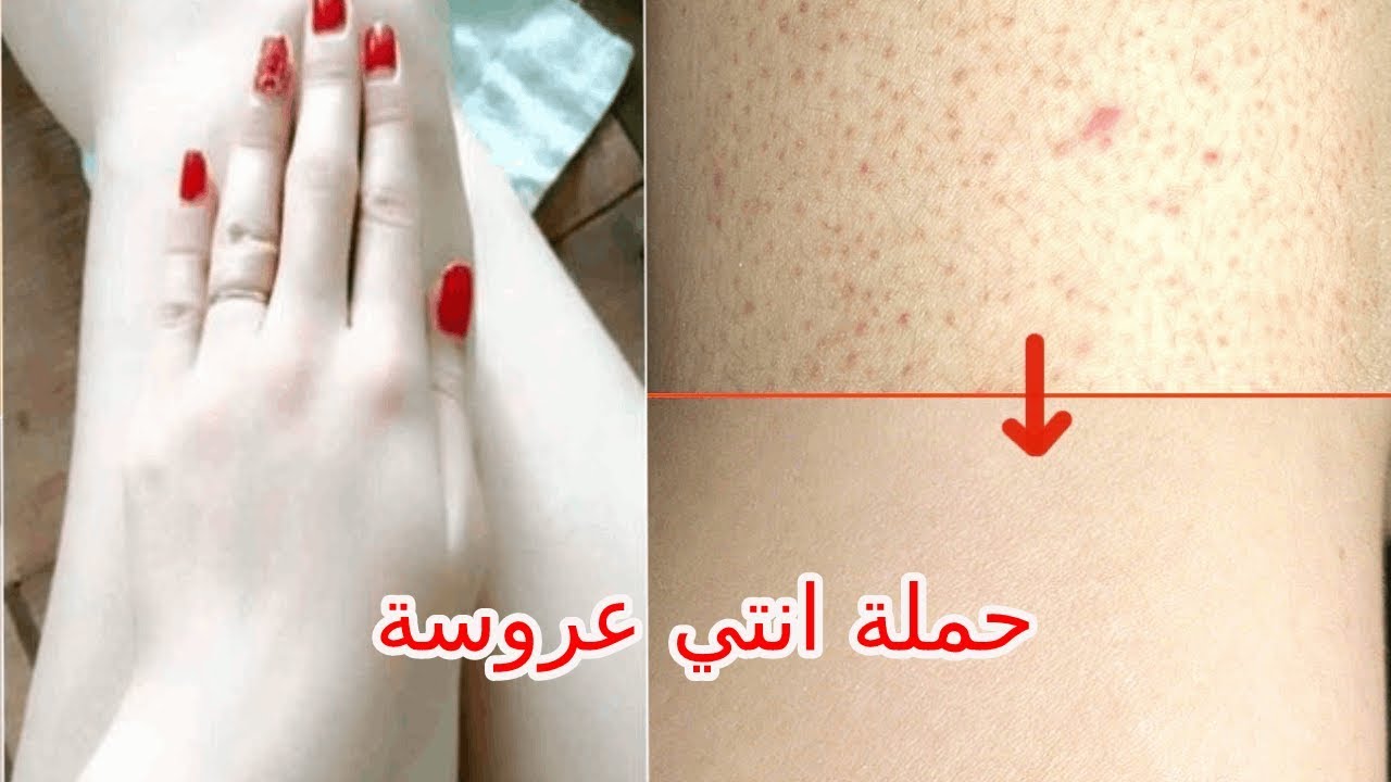 للعرايس.. أقوي خلطات تبييض الجسم والبشرة والتخلص من اسمرار وسواد السنين بطريقة طبيعية 2 للعرايس.. أقوي خلطات تبييض الجسم والبشرة والتخلص من اسمرار وسواد السنين بطريقة طبيعية