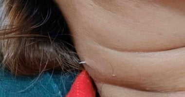 شوكة سمك تعلق في حلق امرأة وتظهر في رقبتها دون اكتشافها بالأشعة السينية